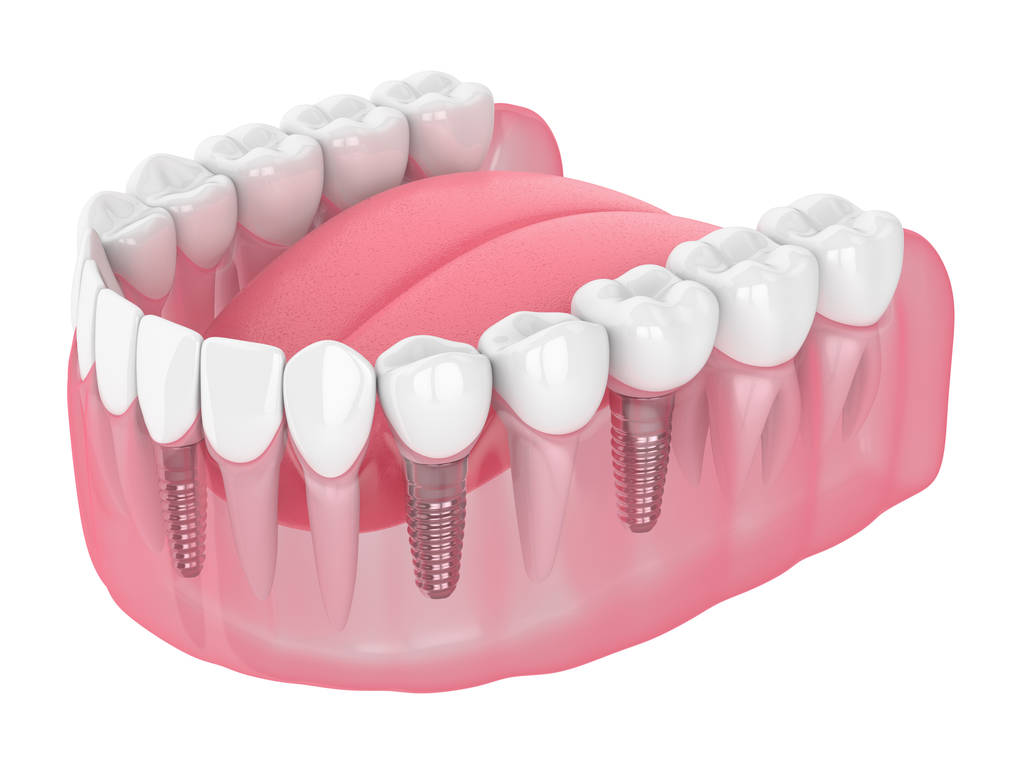 Who Does Dental Implants Perth WA