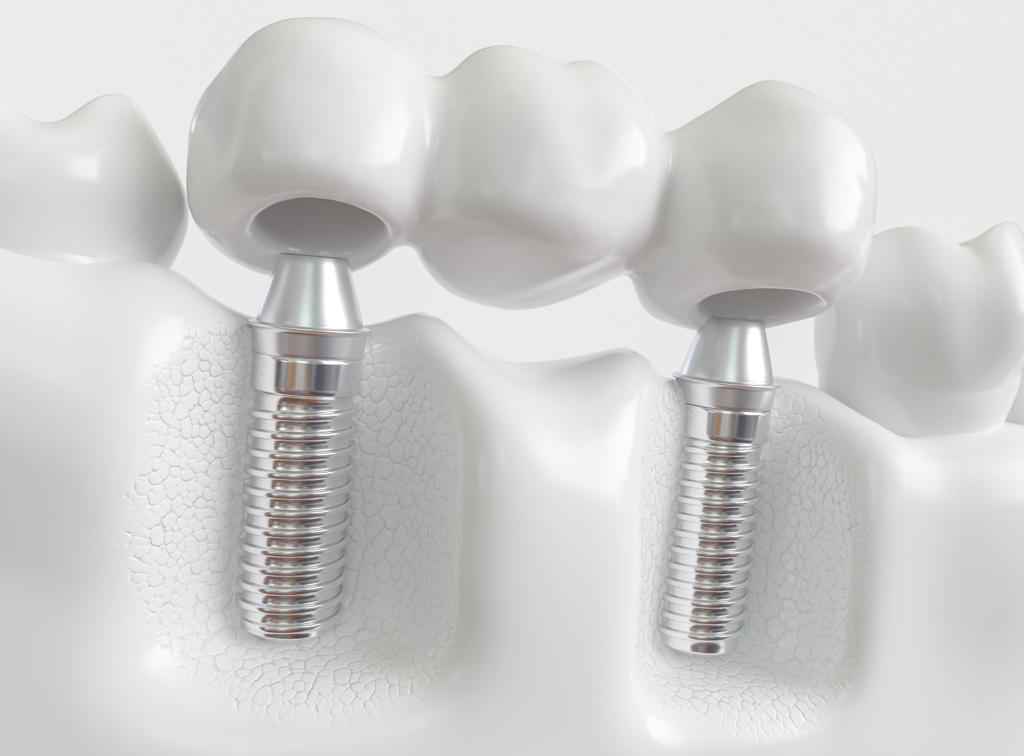 How Much Does a Dental Implant Cost in Australia?