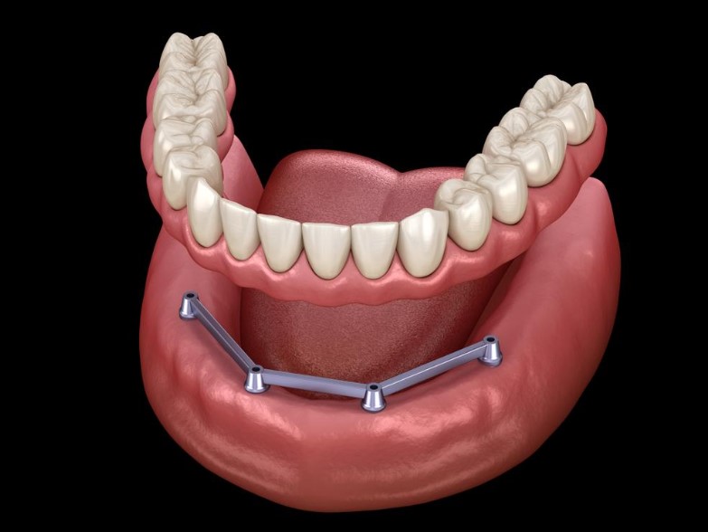 all on 4 dental implant